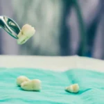 Tooth Extraction
