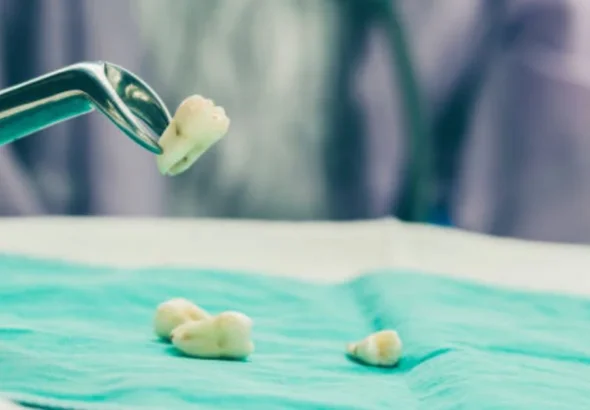 Tooth Extraction