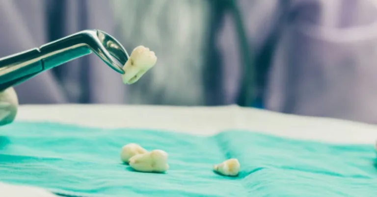 Tooth Extraction