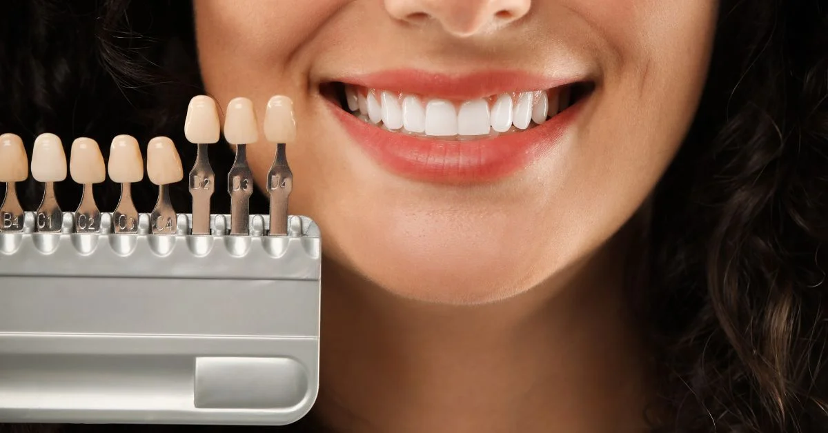 Dental Veneers